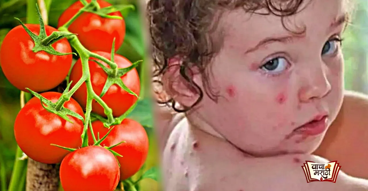 Tomato Flu in India Know the symptoms and preventive measures