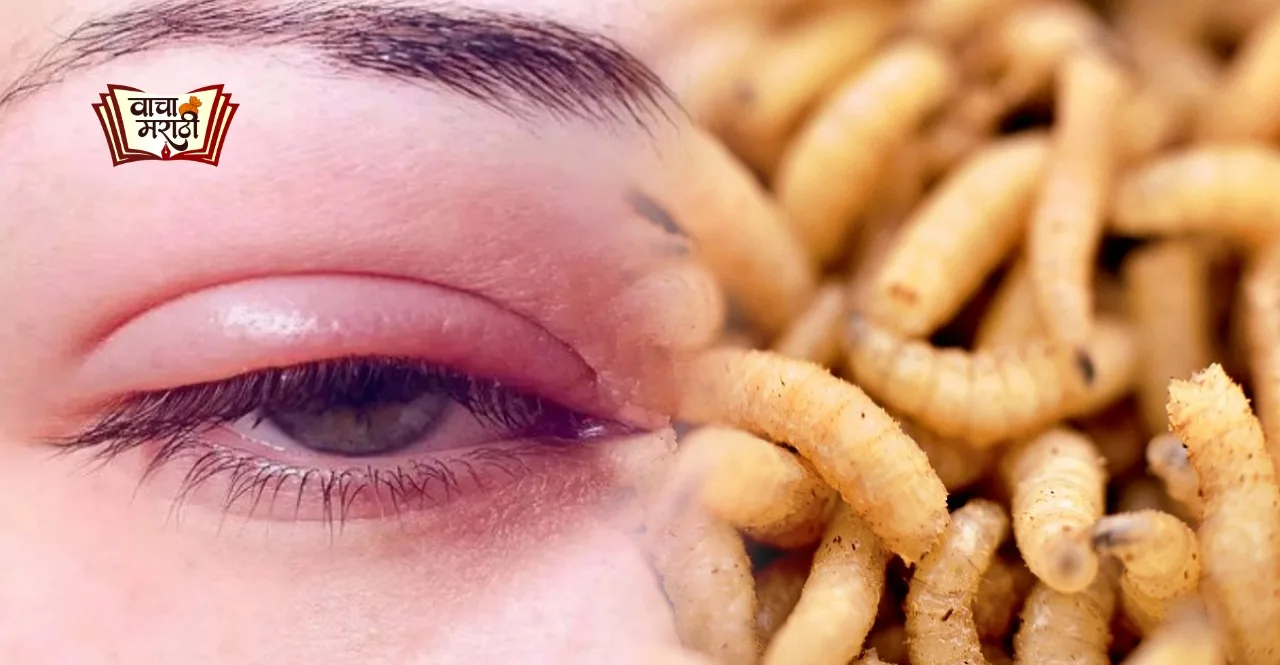 145 Maggots removed from womans eyes and nose in Bengaluru