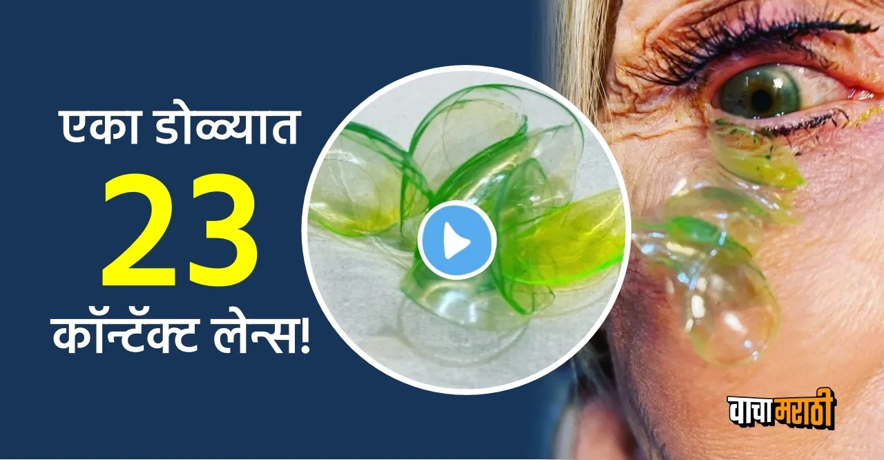 Viral Video Doctor removed 23 contact lenses from womans eye