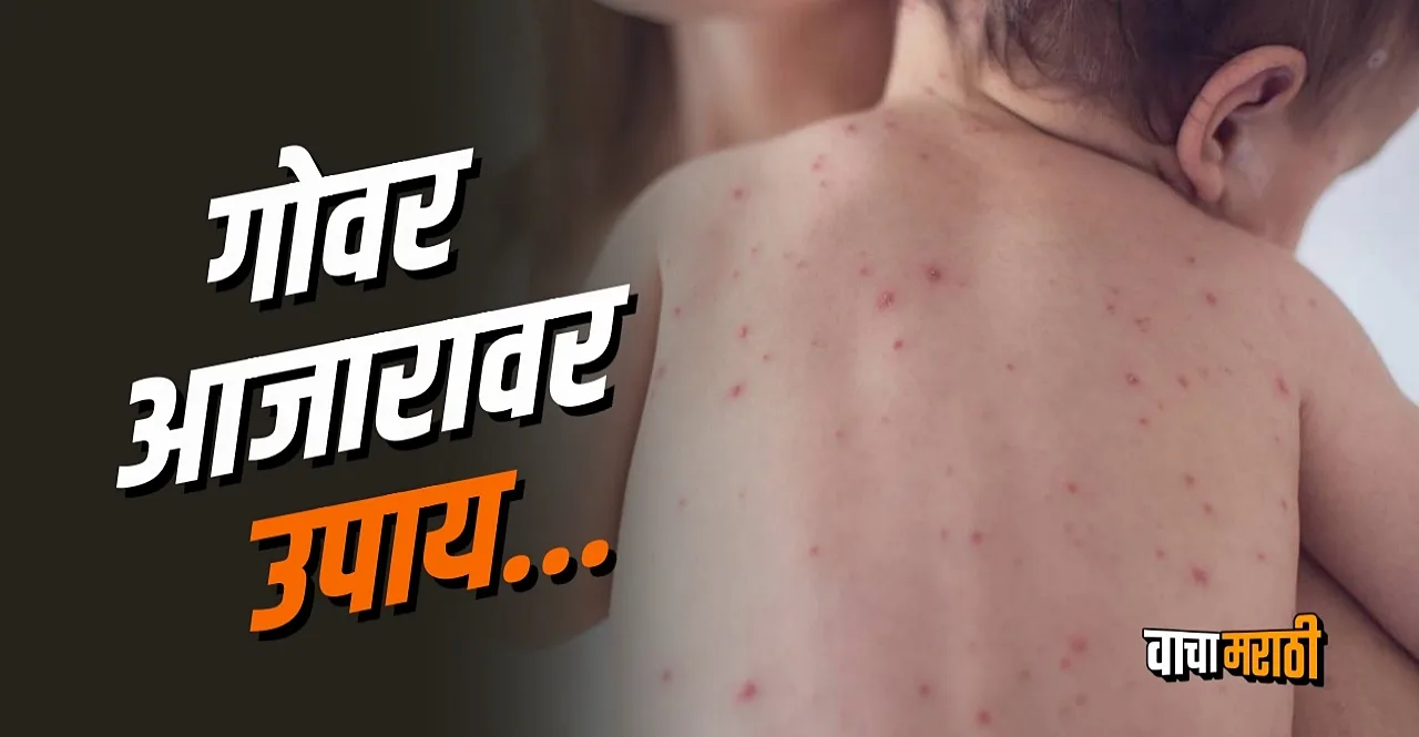 Measles outbreak in Mumbai know