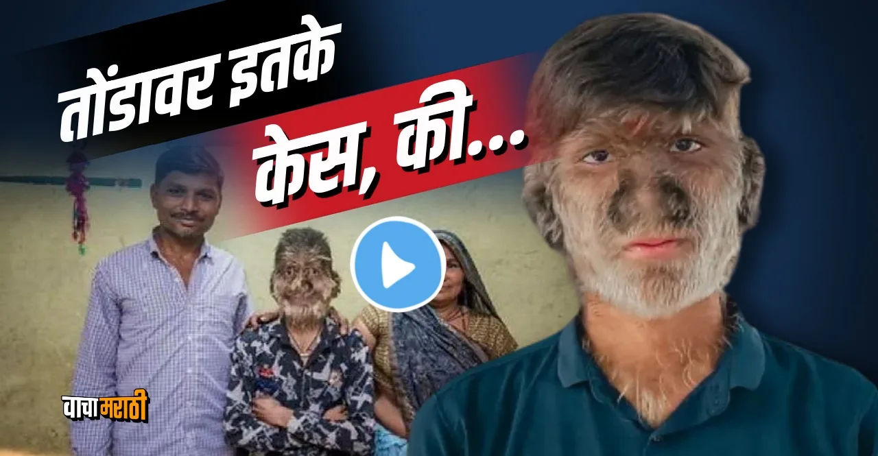 Madhya Pradesh 17 year boy Lalit Patidar with rare werewolf syndrome