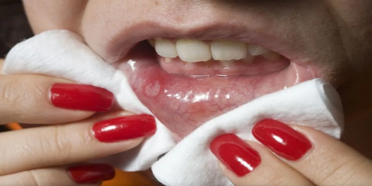 Home Remedies for Mouth Ulcer