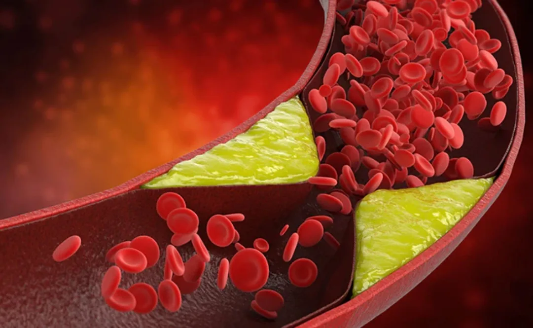Home Remedies to Reduce Bad Cholesterol