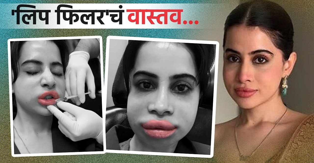 Urfi Javed Lip Filler